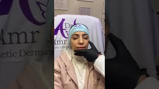 حقن الفيلر لرفع و ملئ الخدود💉 Dr Amr Kotb Clinic Cheek lifting by fillers💉 [upl. by Bonni]