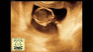 Axillary lymphangioma fetal ultrasound [upl. by Ailad623]