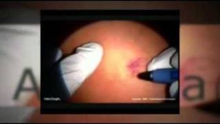 VeinGogh  Spider Angioma Treatment [upl. by Lorrin242]