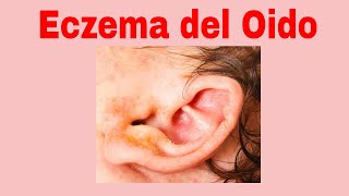 Eczema del Oido  Causas  Sintomas  Tratamiento [upl. by Allyce801]