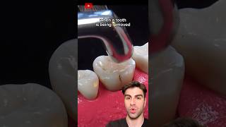 Tooth Extraction The ACTUAL Process Explained [upl. by Netsirc]