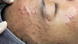 ACNE TREATMENT VU QUYNH MI  Perennial Blackheads On Boy Face 2024FULL [upl. by Gulick247]