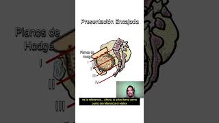 MECANISMO DEL TRABAJO DE PARTO Presentación ENCAJADA Aclarando una duda ¡MUY COMÚN [upl. by Milena]