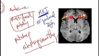 Video 217 Overview of Demyelinating Disorders Clinical Features Diagnostics and Risk Factors [upl. by Yevi]