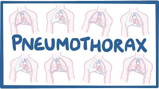 Pneumothorax  causes symptoms diagnosis treatment pathology [upl. by Libby]