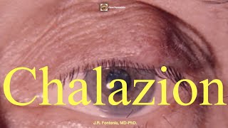 Chalazion [upl. by Reilamag]