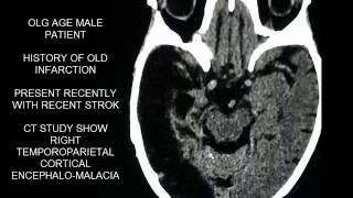 CASE 294 CT BRAIN ENCEPHALOMALACIA [upl. by Sally757]