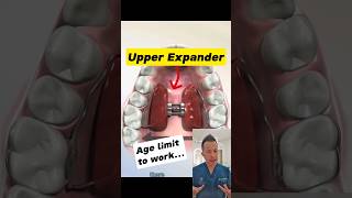 Best Age for Upper Expander Ideal Age Revealed dentallan dentist shorts [upl. by Amann]