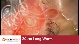 20 cm Long Worm In The Human Eye First Ever Recorded On Video  India Video [upl. by Obadiah374]