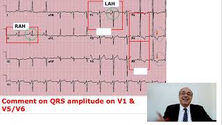 EKG Trainer Case 5 Answer [upl. by Sonny]