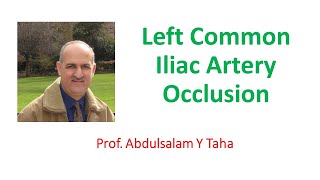 Left Common Iliac Artery Occlusion [upl. by Sufur]