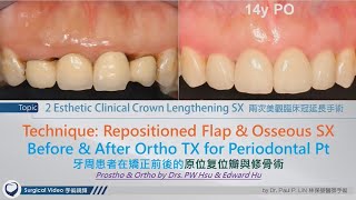 Esthetic Clinical Crown Lengthening Surgeries [upl. by Maurene]