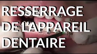 Resserrage de lappareil dentaire  Appareildentaireinfo [upl. by Eiddet]