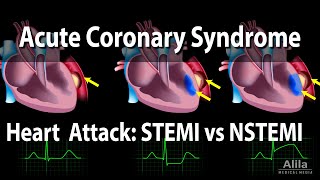 Acute Coronary Syndrome Unstable Angina NSTEMI and STEMI Heart Attack Animation [upl. by Ittocs]