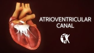 Atrioventricular Septal Defect  AV Canal [upl. by Aileduab415]