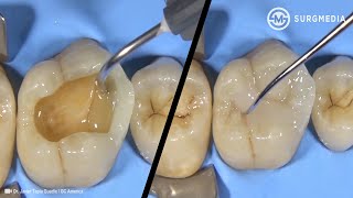 Step by Step Dental Filling Cavity Filling  Tooth Filling Cusp BuildUp of a Molar [upl. by Miguel29]