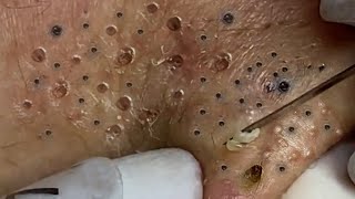 Treatment Of Blackheads Hidden Acne On The Face At Sac Dep Spa [upl. by Elleynod371]