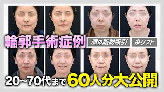 【年代別】女性の輪郭手術 症例特集！顔の脂肪吸引・糸リフト・バッカルファット、輪郭手術全分野で全国No1の症例数を持つドクターのビフォーアフターを一気に“60人分”大公開！【20〜70代まで】 [upl. by Aihsyak]