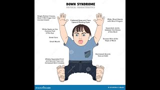 MEOTIC ERRORS  NON DISJUNCTION OF CHROMOSOMES  DOWN SYNDROME  KLINEFILTER SYNDROME  TURNER SYNDR [upl. by Leahkim415]