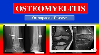 OSTEOMYELITIS  Definition types causes pathophysiology signs amp symptoms medicine [upl. by Lered846]