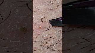 Ingrown Beard Hair [upl. by Eiser]