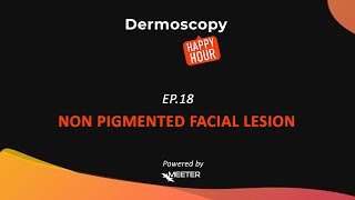 Dermoscopy Happy Hour  SEASON 2 EPISODE 18 quotNON PIGMENTED FACIAL LESIONquot [upl. by Elmina]