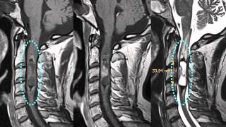 Spinal Masses  Location Intramedullary Ependymoma [upl. by Brunk149]