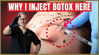 How To Inject Botox Under The Brow  Botox Brow Lift Advice [upl. by Annitsirhc]