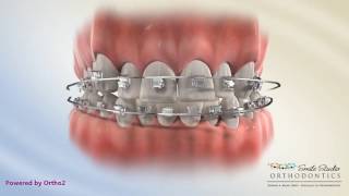 Damon Posterior Crossbite   Orthodontic Treatment [upl. by Joacima]