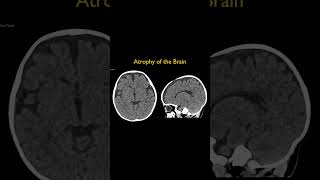 Atrophy of the Brain [upl. by Marika]