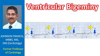 Ventricular Bigeminy [upl. by Amati]