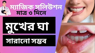 How To Treatment Aphthous ulcer  Canker Sores  Mouth Ulcer  orofresh OS জীবনসমস্যার সমাধান [upl. by Ativel]