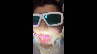 Lingual frenectomy with diode laser epic 10biolase companyby Dr Ali Heidari [upl. by Nyrrat]