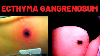 WHAT IS ECTHYMA GANGRENOSUM Causes Symptoms [upl. by Ardnikat660]