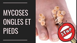 Mycoses des pieds et des ongles  Larme absolue pour sen débarrasser rapidement [upl. by Rendrag]