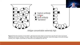 HYPERPROLACTINEMIA AND PROLACTINOMA [upl. by Pinzler]