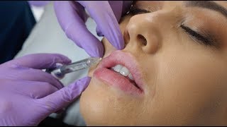 Lip Fillers  what to expect during the procedure  The Laser amp Skin Clinic [upl. by Anewor765]