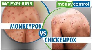 Monkeypox How Is It Different From Chickenpox  Explained [upl. by Anaidiriv]