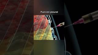 🩺 ¿Qué es la punción pleural Descubre todo sobre este procedimiento médico 👨‍⚕️ [upl. by Yrot]