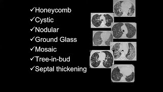 Chest CT Patterns  Honeycomb Cystic Nodular Ground Glass Mosaic Trrinbud Septal Thickening [upl. by Aslin]