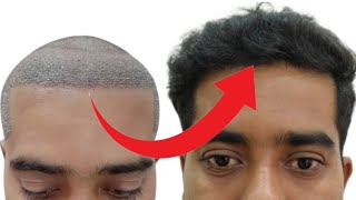 hairtransplant hairtransplantclinic besthairtransplant besthairtransplantresults viralvideo [upl. by Nothgierc]