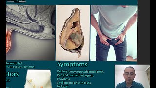 Testicular Cancer Symptoms causes and treatment [upl. by Aggappe778]