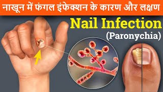 नाखून में फंगल इंफेक्शन होने का के कारण और लक्षण  Nail Infection Paronychia  Cause amp Treatment [upl. by Tuppeny]