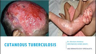 SKINCUTANEOUS TUBERCULOSIS BY DR ABRAHAM TB ulcers funny viralvideo education dermatology [upl. by Zerla]