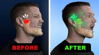 The Revolutionary New Fix For TMJ amp Jaw Pain [upl. by Anilat113]