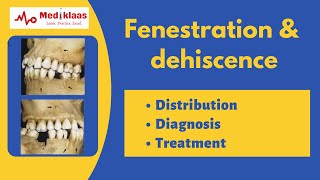 Fenestration and Dehiscence l Periodontal anatomy l Mediklaas [upl. by Theodore]