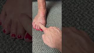 What causes hammer toes hammertoes [upl. by Leisha]