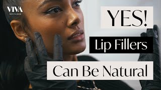 Natural Lip Filler Procedure 👄 Before amp After of Subtle and Delicate Lip Modification [upl. by Cornwell]