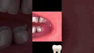 ضرس العقل  third molar [upl. by Raffarty]