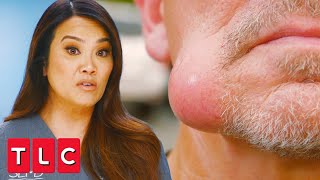 Squeezing Out a Swollen Jaw Lump  Dr Pimple Popper A Pimple Carol [upl. by Eno]